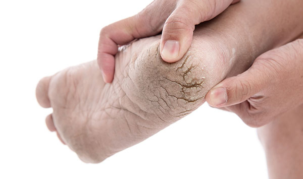 Calos e calosidades: o que fazer para acabar com esse problema?