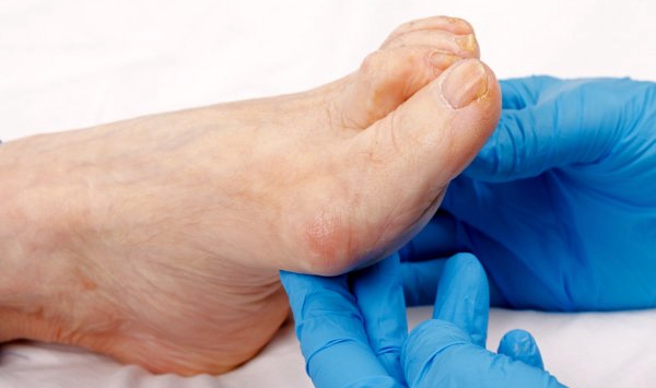 Por que idosos e diabéticos têm mais micoses e são mais difíceis de tratar?