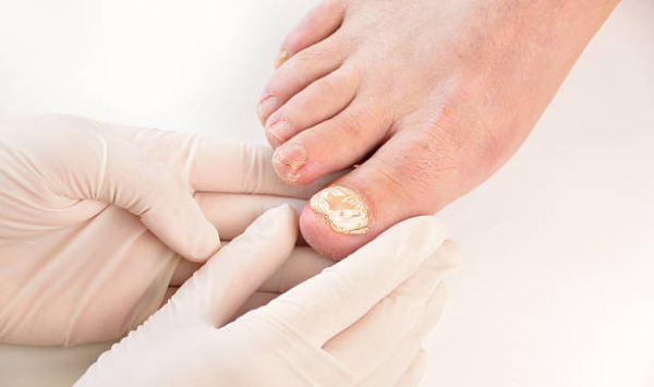 Como saber se estou com micose de unha? Sintomas e Diagnóstico