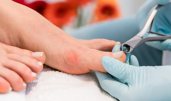 Conheça os tratamentos e saiba o que fazer com uma unha encravada