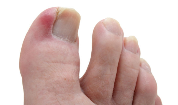 Saiba como tratar unha encravada inflamada