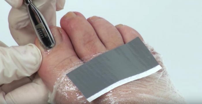 Utilizando o afastador nas cutículas